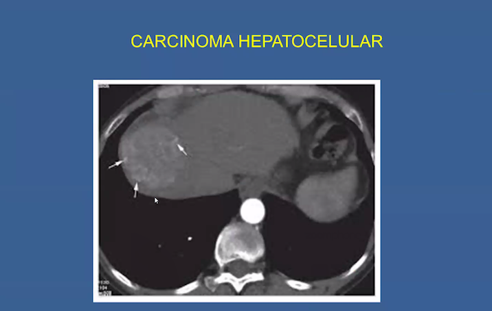 México Ocupa el Segundo Lugar en Mortalidad Por Cáncer de Hígado (HEPATOCARCINOMA), en el Mundo