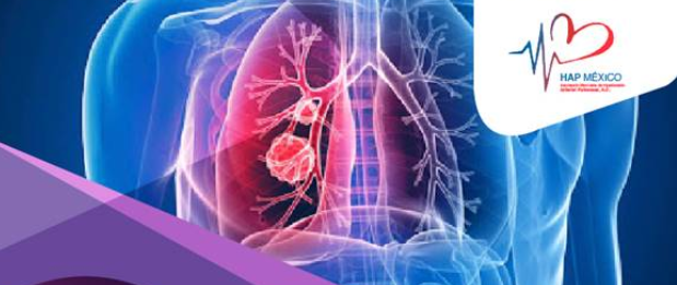 HIPERTENSIÓN PULMONAR. ENFERMEDAD RARA, Y POTENCIALMENTE FATAL