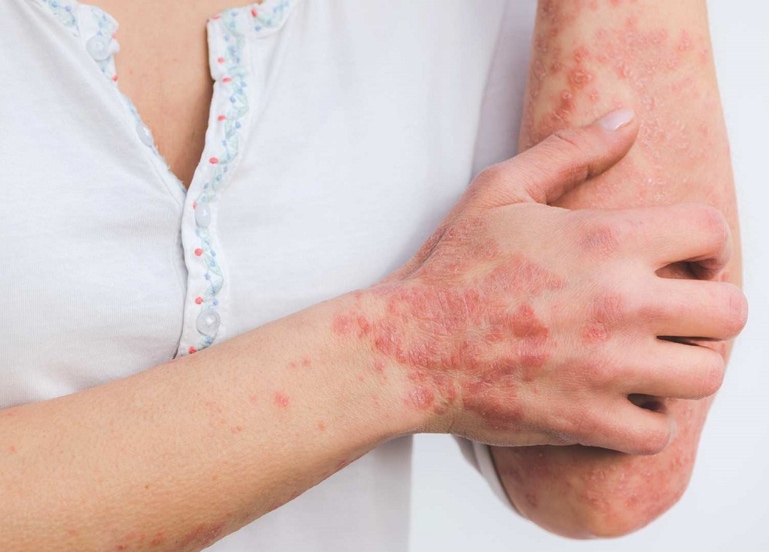 PSORIASIS PUSTUAR GENERALIZADA: Enfermedad Desconocida, Grave y Potencialmente Mortal